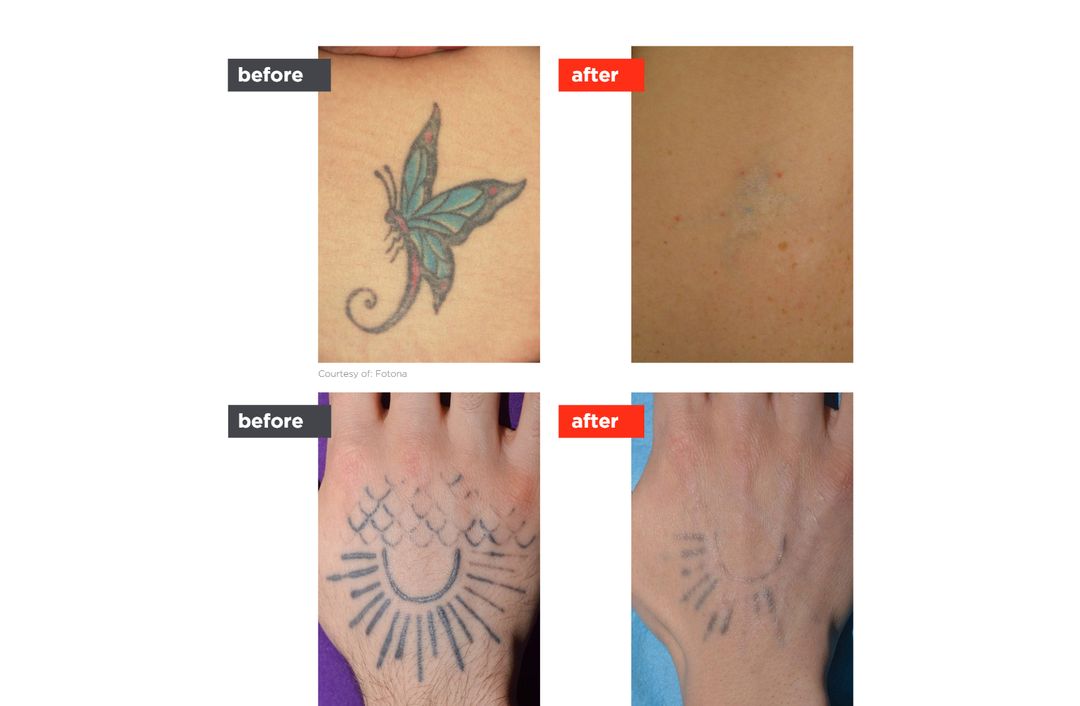 tattoo removal before and after, The Derm Edit
