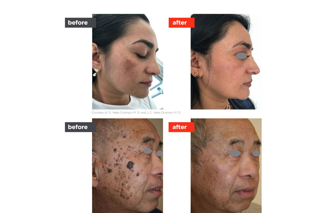 lesion removal before and after, The Derm Edit