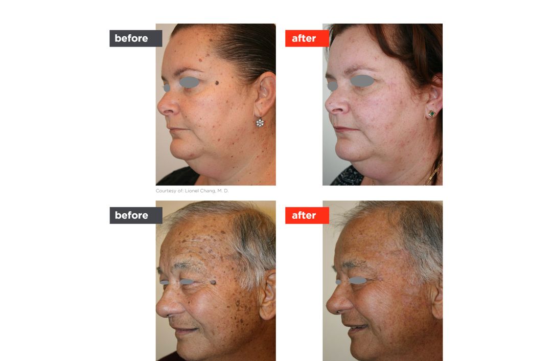 lesion removal before and after, The Derm Edit