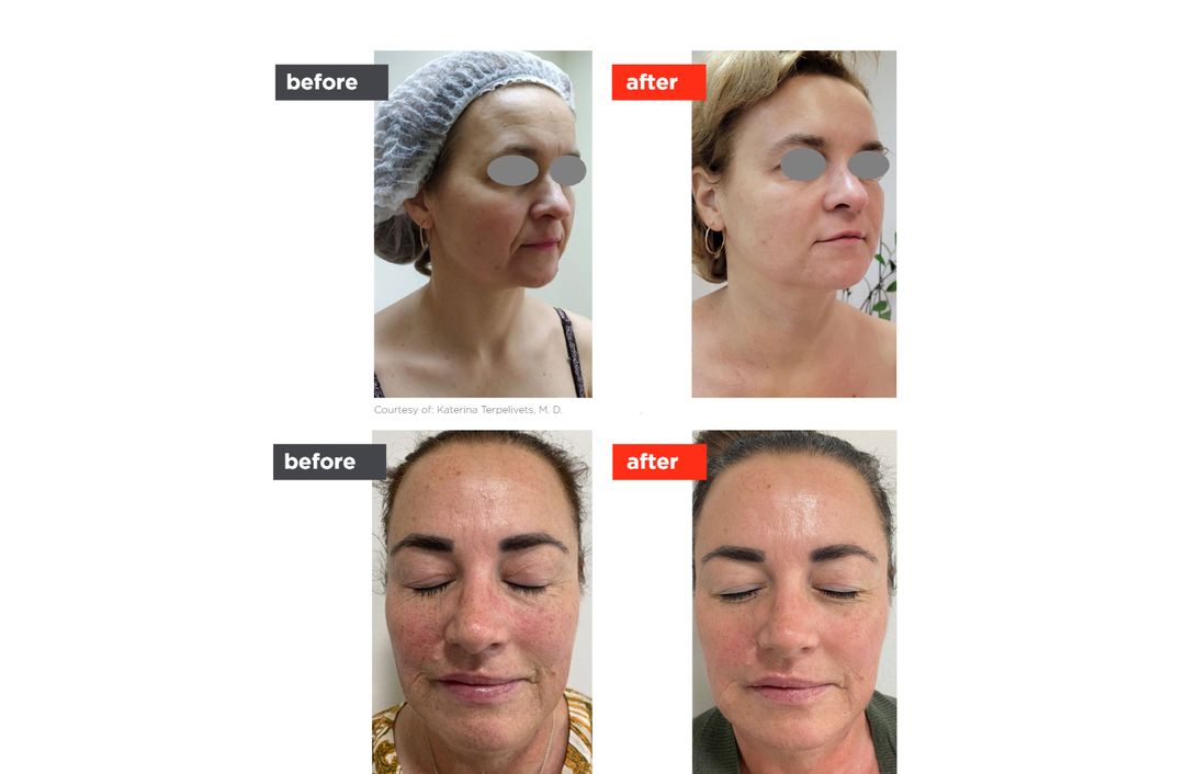 Fotona4D® before and after, The Derm Edit