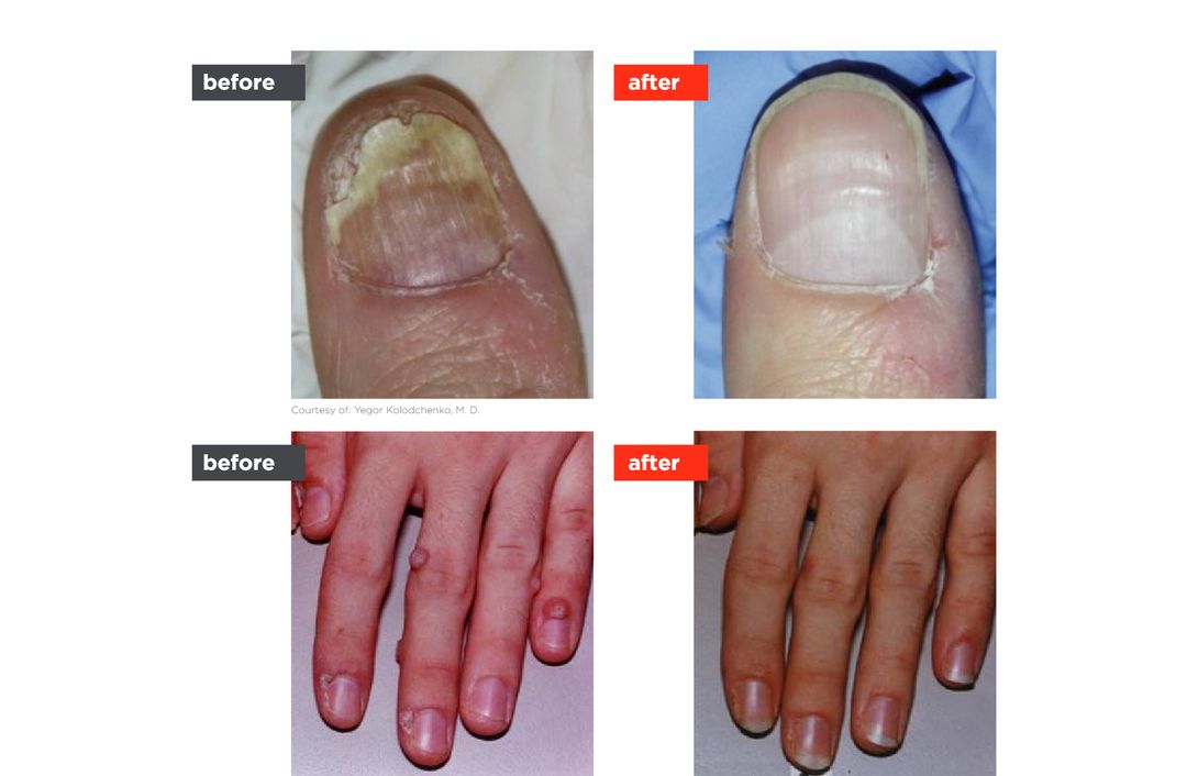 ClearSteps® nail before and after, The Derm Edit