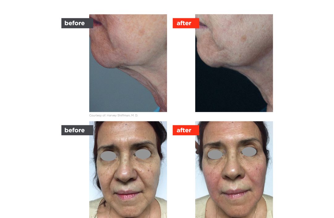Fotona4D® before and after, The Derm Edit