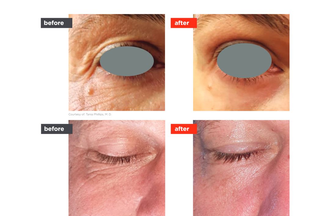 SmoothEye® before and after, The Derm Edit
