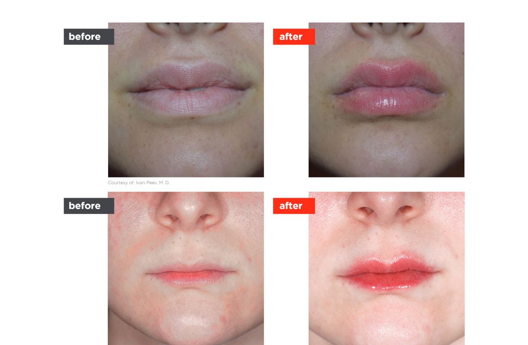 LipLase™ before and after, The Derm Edit