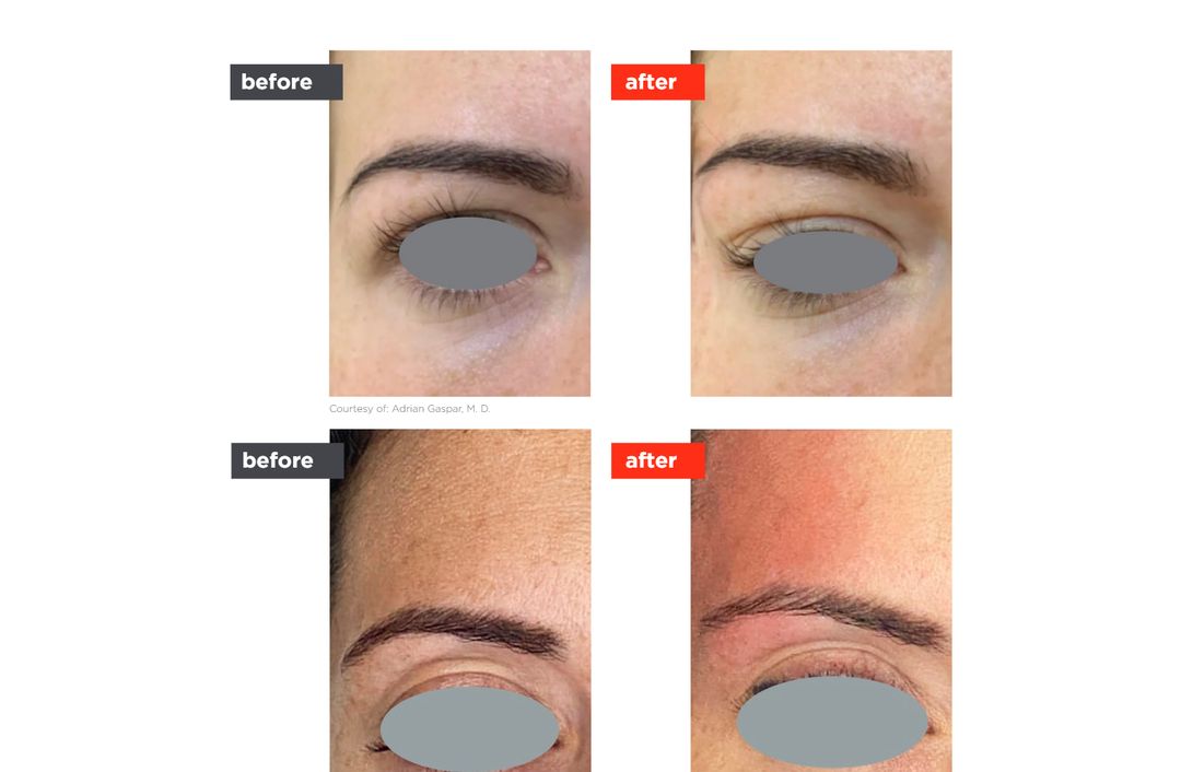 VectorLift® before and after, The Derm Edit