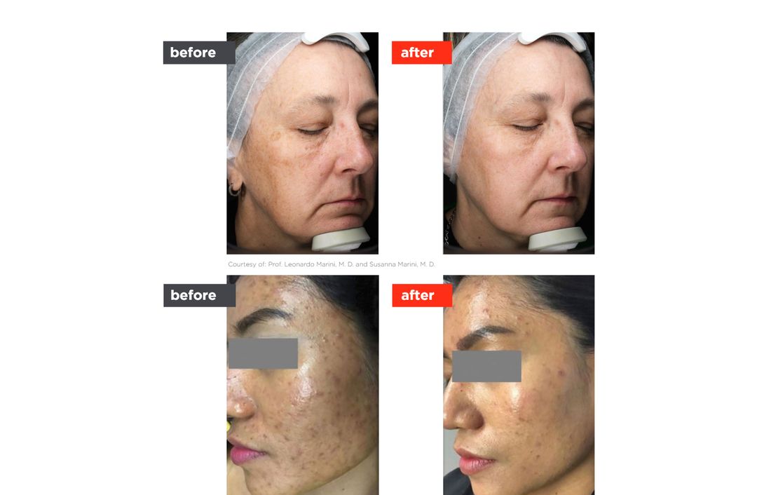 laser toning before and after, The Derm Edit