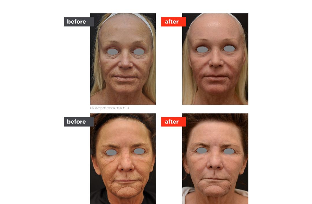 laser resurfacing before and after, The Derm Edit