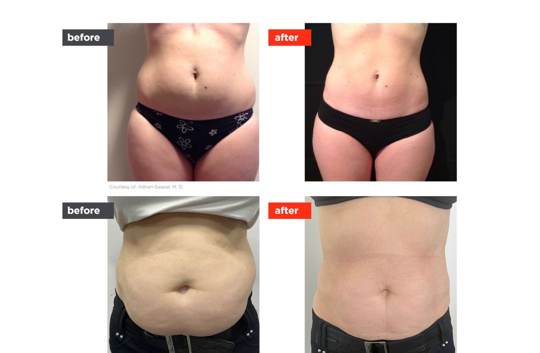 TightSculpting® before and after, The Derm Edit