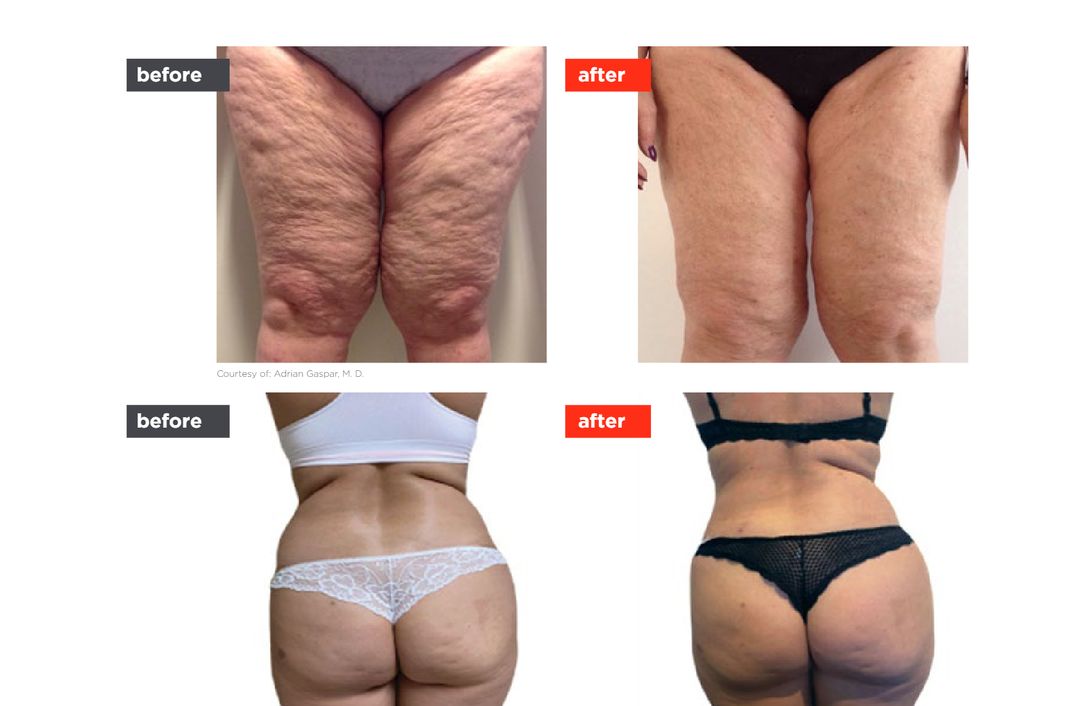 OrangeLase before and after, The Derm Edit