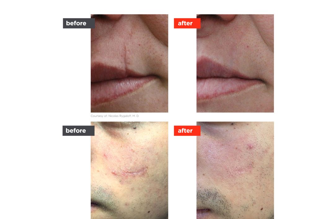 scar laser before and after, The Derm Edit