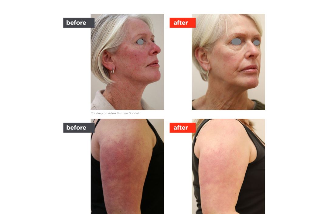 vascular laser before and after, The Derm Edit