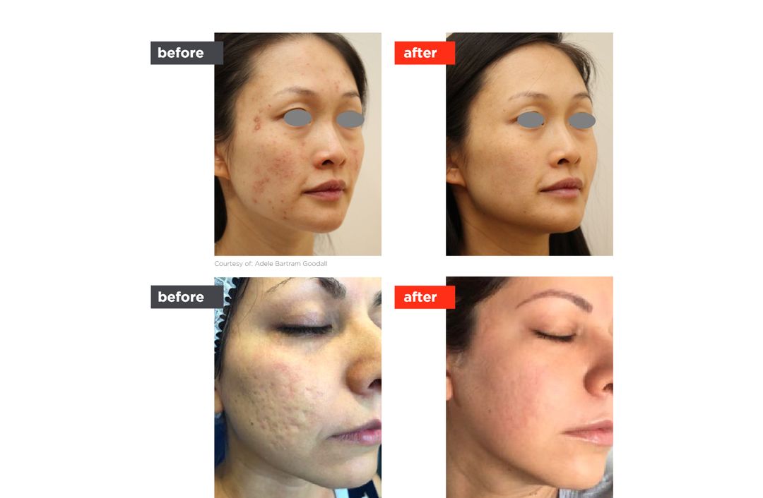 acne laser before and after, The Derm Edit