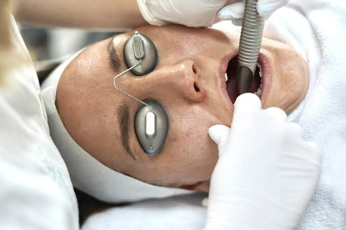 Fotona 4D SmoothLiftin is performed inside the mouth with a clinician-controlled intraoral laser handpiece while the patient wears protective eye shields.