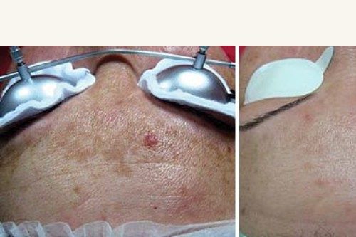 Manufacturer-hosted clinical comparison labelled “Melasma Treatment” on Fotona's StarWalker MaQX product page. Courtesy/source: Fotona; clinical photographs credited there to Dr Kozarev. Individual responses vary.