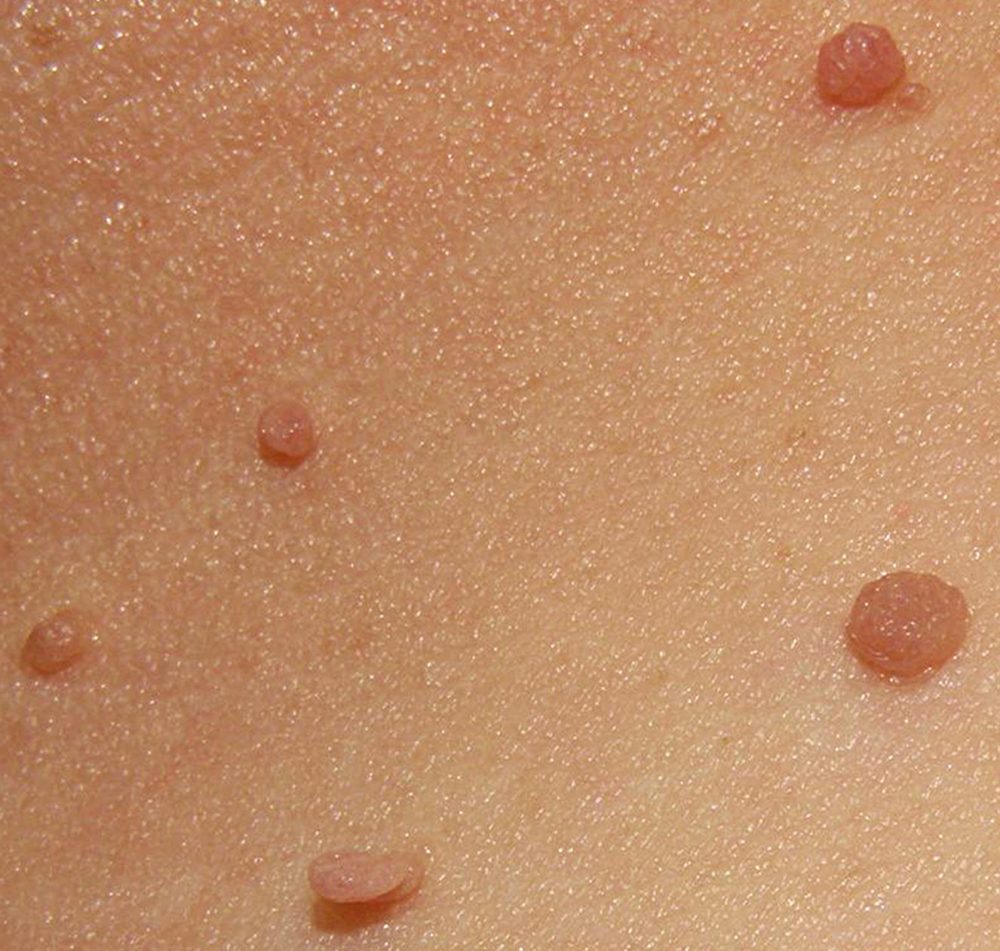 Skin tags on the lower neck. Photo: Jmarchn via Wikimedia Commons, CC BY-SA 3.0 (creativecommons.org/licenses/by-sa/3.0/); displayed without cropping.