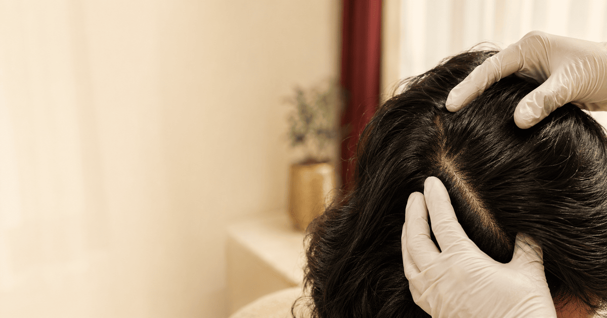 Can dandruff cause hair fall? What dermatologists actually check